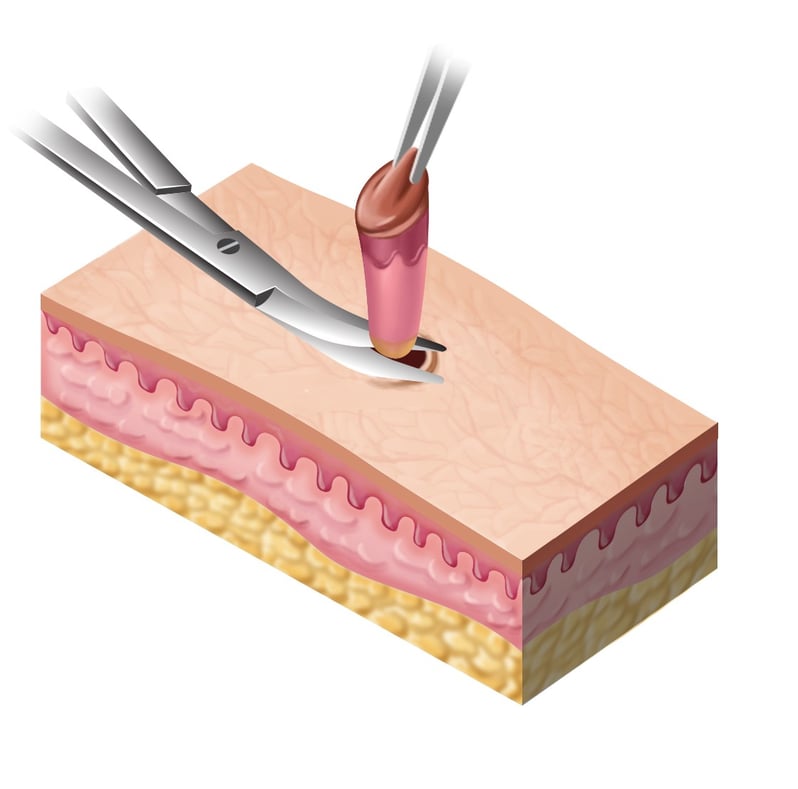 biopsy-to-confirm-diagnosis-national-skin-cancer-centres